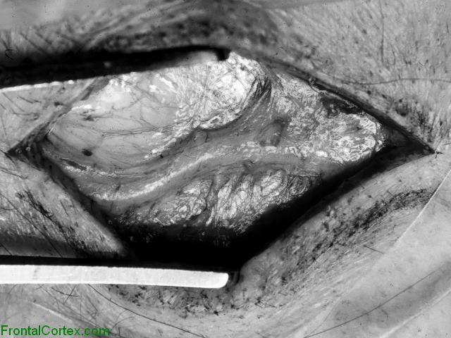 Temporal Artery, Surgical Exposure